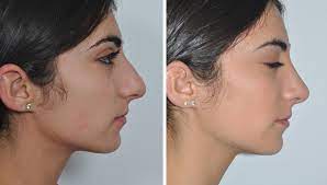 We did not find results for: How Much Does Rhinoplasty Cost