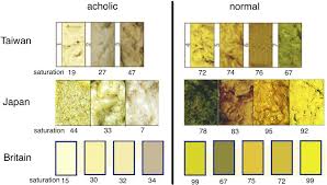 Image result for acholic stools human