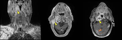 Image result for Necrotizing Otitis Externa