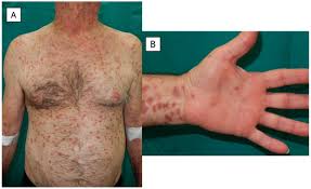 Image result for Secondary Syphilis