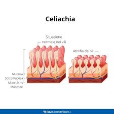 Ecco gli alimenti che non devono mancare nell'alimentazione. Celiachia Cause Sintomi Test E Dieta Gluten Free