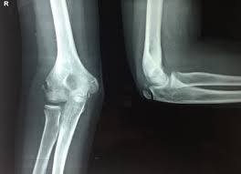 Tennis elbow assessment online course: A X Ray Showing Posterior Elbow Dislocation With Displaced Medial Download Scientific Diagram