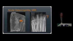 Image result for Osteomyelitis