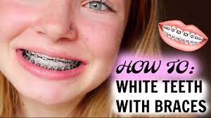 Teeth staining after braces is a common concern among braces patients. How I Maintain White Teeth With Braces Youtube