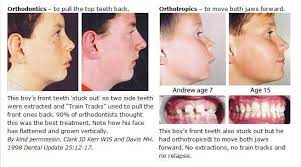 Orthodontics Vs Orthotropics Orthodontics Health And Safety Plastic Surgery