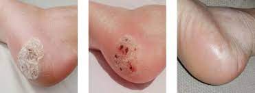 We did not find results for: Blood Blister On Foot Beaver Valley Foot Clinic