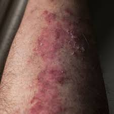 Image result for Neurodermatitis