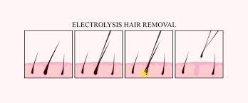 There are many electrolysis devices available online and in beauty stores. Is Electrolysis Hair Removal Painful 2pass Clinic