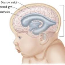 Pdf Recent Advances In Rational Diagnosis And Treatment Of Normal Pressure Hydrocephalus A Critical Appraisal On Novel Diagnostic Therapy Monitoring And Treatment Modalities