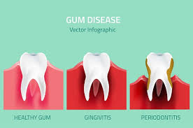 Image result for Gingivitis