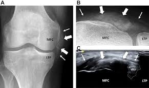 Image result for XRay Changes in Rheumatic Conditions