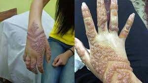Merinding Bikin Tato Henna Jelang Pernikahan Kulit Perempuan Ini Malah Berubah Jadi Mengerikan Tribun Jabar