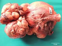 Image result for Leiomyosarcoma
