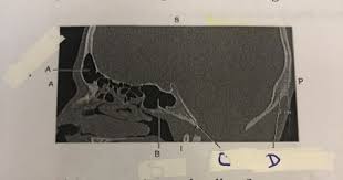 Abnormal heart sounds called _ can indicate valve problems. Cross Sectional Anatomy Final Pictures Flashcards Quizlet