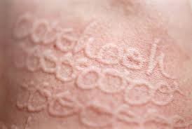If You Have This Condition You Can Write On Your Skin No Pen Required Skin Art Skin Skin Conditions