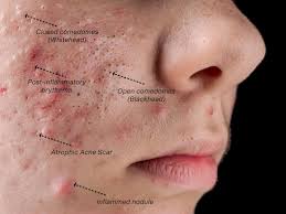 What causes Blackheads & Whiteheads ...