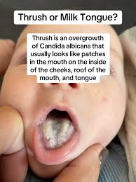 Image result for oral thrush symptoms roof of the mouth