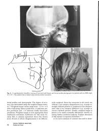 Mesial shift is a term used in pediatric dentistry with respect to permanent first molars. Https Www Aapd Org Globalassets Media Publications Archives Fields 01 01 Pdf