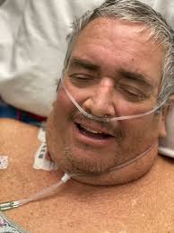 Looking much better today. Taking a break from C-Pap.