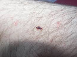 Angiomas are caused by an accumulation of capillaries if the bleeding does not stop, get the angioma treated. Cherry Hemangioma