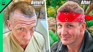 $3000 Thai Hair Transplant!! Was This a Mistake??