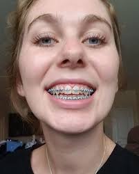 Braces Girlswithbraces Metalbraces Elastics Cute Braces Braces Colors Teeth Braces