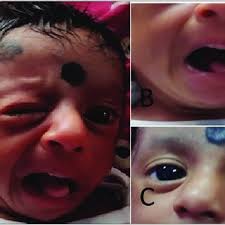 PDF) Moebius Syndrome: A Rare Entity or a Missed Diagnosis?