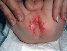 Image result for dermatitis contacta toxica
