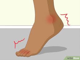 Image result for gout symptoms toe