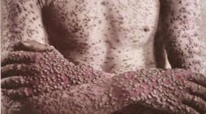 Si tratta di un patogeno appartenente alla famiglia dell'herpes che infetta i macachi. Uomo Contagiato Dal Vaiolo Delle Scimmie Prima Volta In Europa Non Esiste Ancora Un Vaccino Tutto Per Lei