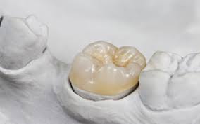 The black rectangle around the rim piece on the. Allentown Metal Free Restoration All Ceramic Crowns Tomko Dental Associates