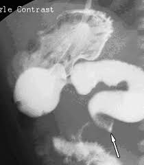Image result for Midgut Volvulus