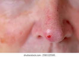 Image result for skin cancer on nose pimple