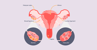 Symptoms of polycystic ovarian syndrome include irregular periods, heavy bleeding, and weight gain. What Is Polycystic Ovarian Syndrome Or Pcos Regency Healthcare Ltd