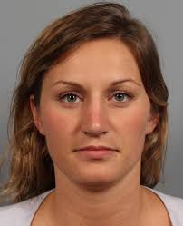 Rhinoplasty Before and After Photos by Gregory Mackay, MD; Atlanta, GA