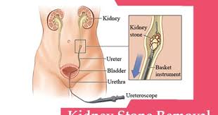 Kidney Stone Removal Kidney Stones Kidney Surgery Kidney