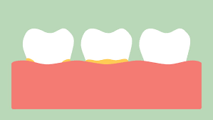 English language learners definition of gingivitis. Plaque On Gum Before Gingivitis Stock Footage Video 100 Royalty Free 34596424 Shutterstock
