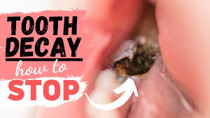 Tooth Decay Treatment For A Tooth Cavity Youtube