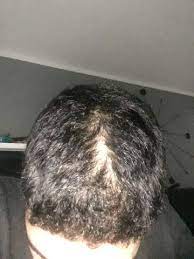 Kahle Stelle Am Kopf Mit 14 Haare Haarausfall 14 Jahre Alt