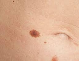 The main types of skin cancer are squamous cell carcinoma, basal cell carcinoma, and melanoma. Melanoma Monday Skin Cancer Facts