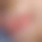 Image result for spinocellular carcinoma of the oral cavity