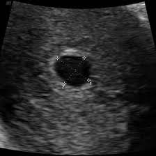Image result for First Trimester Ultrasound