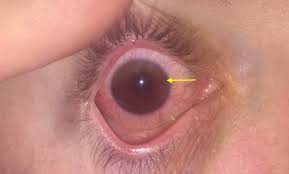 Image result for Hyphema