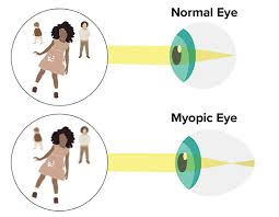 Image result for Myopia