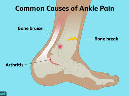 Install and start app (get unlock code) Everything You Need To Know About Ankle Pain