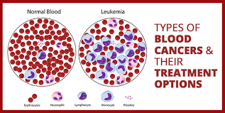 Types Of Blood Cancers And Their Treatment Options