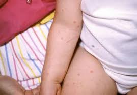 Image result for Papular urticaria