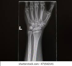 Image result for Wrist XRay