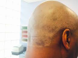 The signs can be mild to severe especially on your scalp, neck, forehead, ears and the eyelids. P344 Chemical Leukoderma In The Setting Of Hair Dye Allergy Annals Of Allergy Asthma Immunology