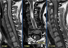 Image result for Myelitis
